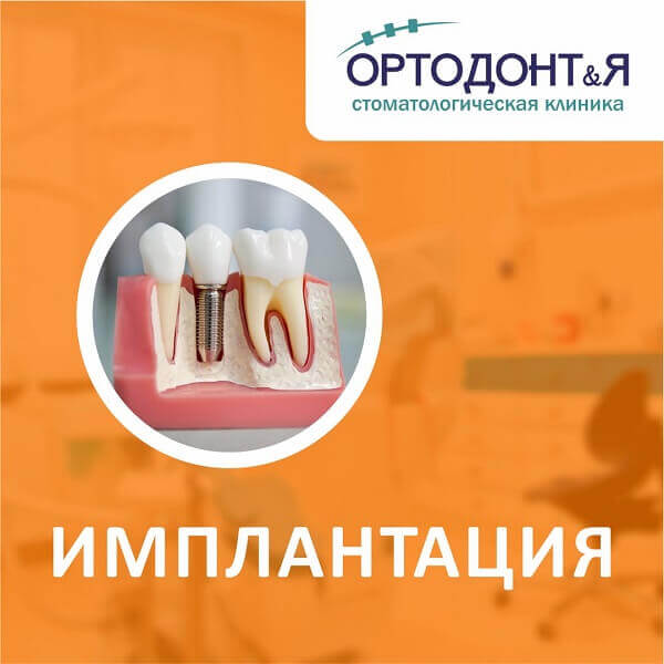 Имплантация после удаления зубов Установка зубных имплантов в Краснодаре