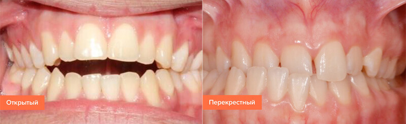 Исправление прикуса у взрослых Исправление неправильного прикуса зубов у взрослых