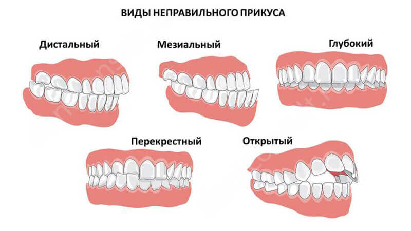 Можно ли исправить прикус? Можно ли исправить прикус у взрослого человека