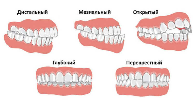 Неправильный прикус челюсти
